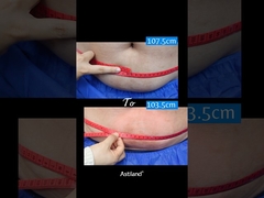 Freeze Lemak, Kehilangan 4 cm dalam 1 jam!