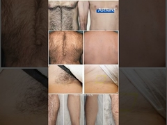 Laser hair removal sebelum dan sesudah