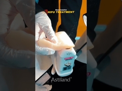 menyaksikan kekuatan angkat non-invasif dari HIFU