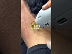 Penghapusan rambut laser ND YAG untuk rambut gelap