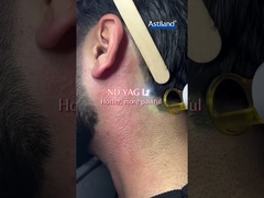 Diode Laser vs ND YAG Laser, mana yang Anda lebih suka?