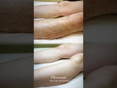 Memperkenalkan Mesin Penghilang Rambut Laser Serat Terbaru, Astiland Fibermax!