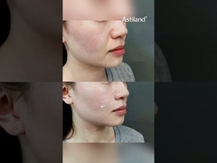 Sudah Pernah Coba RF+ HIFU untuk Mengencangkan Kulit? #AntiPenuaan #PengencanganKulit #klinikkecantikan #perawatanwajah